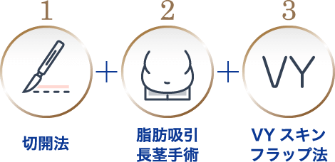 切開法 + 脂肪吸引長茎手術 + VYスキンフラップ法