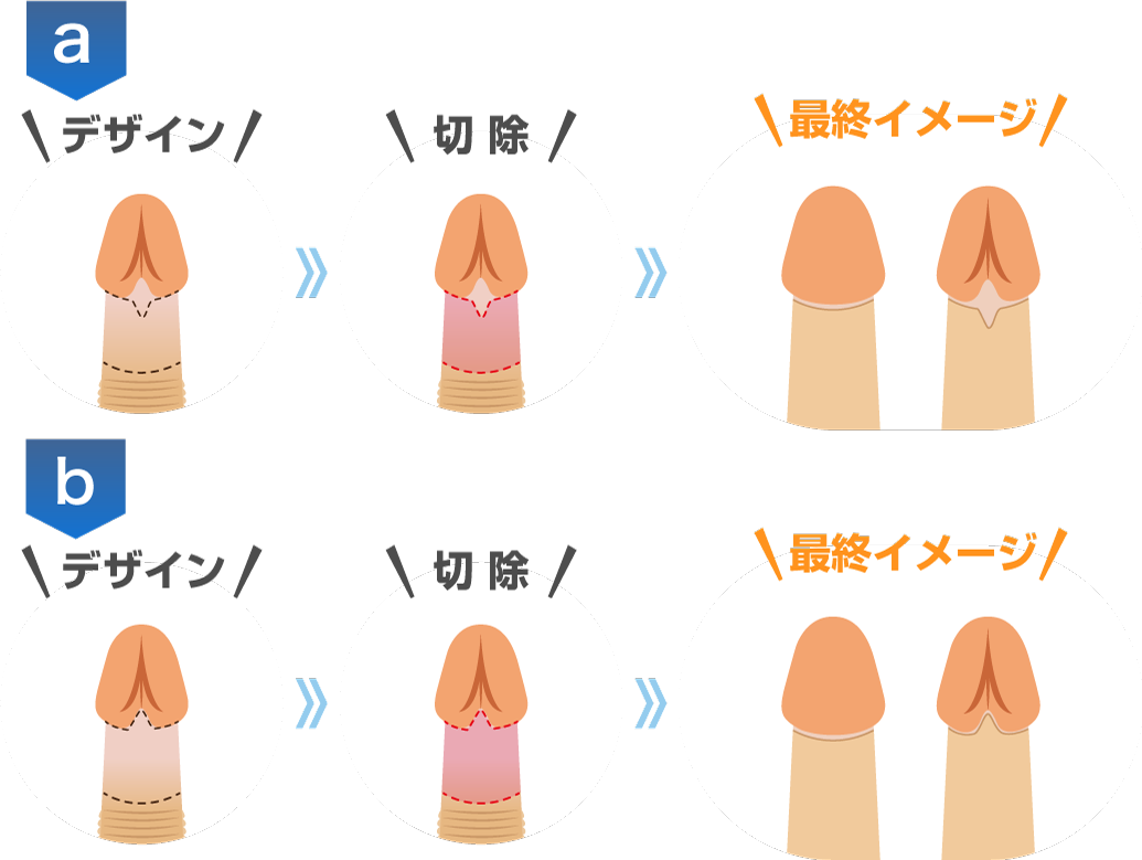 亀頭直下埋没法：直線切開 治療の流れ