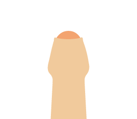 仮性包茎